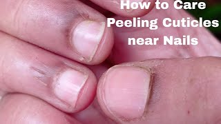 How to take care of Peeling Cuticles near Nails at home  Skin out near Nails  Hacks  Shailaja R [upl. by Wellesley]