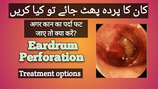 Perforated eardrum treatment  Ruptured eardrum  Kaan ka parda phat jaye to kya kare [upl. by Dibbell]