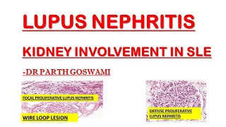 Lupus Nephritis  Wire Loop Lesion [upl. by Hofstetter]