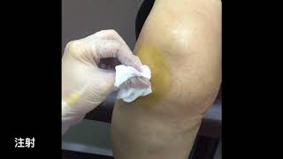 膝關節注射 玻尿酸 美麗新城診所 莊禮謙醫師 Intraarticular injection OA knee [upl. by Sida]