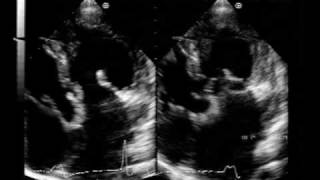 corrected transposition of the great arteriesVSD and pulmonary stenosis [upl. by Coleman]