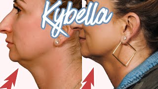 Kybella Experience Getting Rid of my Double Chin Over 40 [upl. by Ellette647]