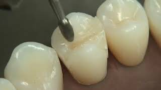 Class II Composite Preparation amp Restoration  Operative Dentistry [upl. by Yauqram]