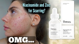 I TESTED THE ORDINARY NIACINAMIDE AND ZINC SERUM FOR MY ACNE SCARS ONE MONTH Shocked by this [upl. by Aduhey837]