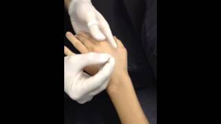 Adductor Pollicis Dry Needling [upl. by Massimo364]