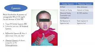 Congenital Heart Diseases Cyanotic Diseases  Fallot Tetralogy 5 [upl. by Honeywell]