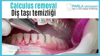 Calculus removal  Diş taşı temizliği [upl. by Ecniv]