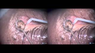 Large naevus on punctum and canaliculus removal with Fugo blade [upl. by Aisital609]