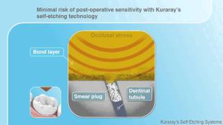 Kuraray Selfetch demonstration  dental use [upl. by Enyawal]