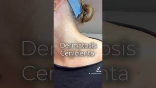 Dermatosis Cenicienta dermatology dermatosis dermatitis manchas rascarse [upl. by Yleen]