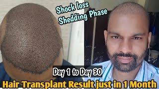 Hair Transplant result  Day 1 to Day 30 Timelapse  Shock loss after hair transplant [upl. by Garling634]