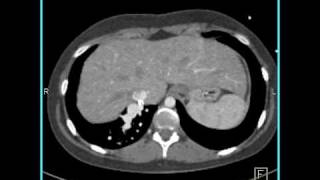 Total anomalous pulmonary venous return [upl. by Huldah209]