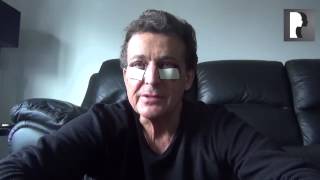 3 Male Blepharoplasty Eyelid Lift Video Diary Day 1 after surgery [upl. by Ammadis]