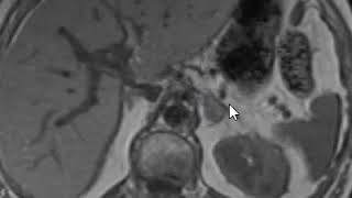 Adrenal adenoma in and out of phase imaging [upl. by Leonid]