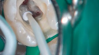 DRendo  Full pulp chamber pulpotomy in a mandibular second molar [upl. by Neeruan325]