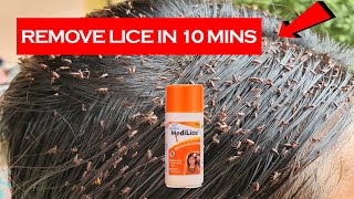 Remove Lice amp Nits in 1 Wash  Instant Rekedy for Lice amp Eggs  Midilice Creme Rinse [upl. by Clarissa242]