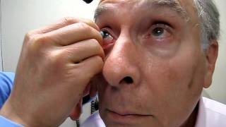 Insertion and Removal of a Scleral Lens [upl. by Nnylatsyrc151]