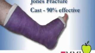 Dr Frank Nisenfeld at MMI  Jones Foot Fracture [upl. by Atteuqcaj773]