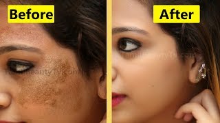 How to Remove Skin pigmentation from face  Beauty Tips in Tamil [upl. by Adnowal696]