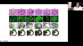 Basics of Renal Pathology  Lupus Nephritis [upl. by Nylinnej]