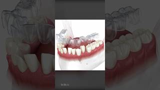 How Does Invisalign Aligners Work To Straighten Teeth [upl. by Hermosa]