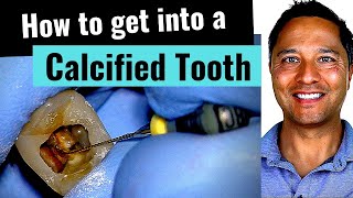 Calcified Tooth How to Root Canal Critical Tips [upl. by Chavaree]