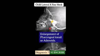 Adenoiditisor tonsillitis  X Ray Neck   Diagnosis  Radiology [upl. by Naujek]