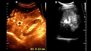 Sonographic Features of Gastric carcinoma  Limitations of Ultrasound  Complementary Imaging [upl. by Gurtner]