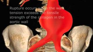 Ruptured Abdominal Aortic Aneurysm [upl. by Sharma]