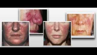 Adios Rosacea 75 De Comision Reviews Grandes Ventas [upl. by Mychael]