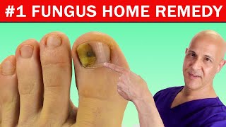 1 Best Home Remedy Cure for Toenail Fungus Dr Mandell [upl. by Beane]