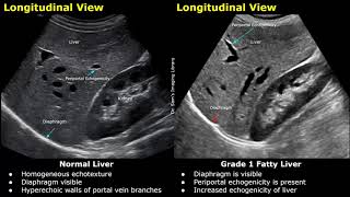 Fatty Liver Grading On Ultrasound  USG Normal Vs Abnormal Images  Grades 12 amp 3 Hepatic Steatosis [upl. by Sorce302]