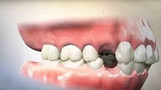 Removing Teeth for Braces  Why Extracting and Retracting Orthodontics is harmful [upl. by Rosalynd]