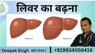 लीवर का बढ़ना लीवर का आकार बड़ा हो जाना Hepatomegaly medical doctor education [upl. by Hyacinth]