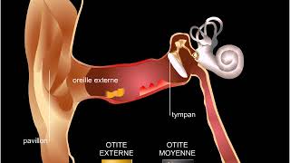 Otite [upl. by Landsman]