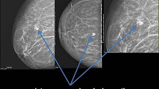 CASE 346 mammography intramammary lymphadenopathy [upl. by Merline]