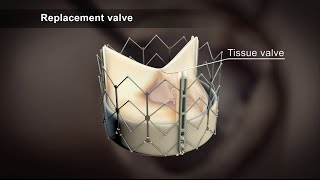 TAVI Transcatheter Aortic Valve Implantation [upl. by Beryle]