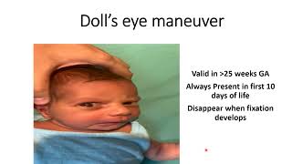 Dolls Eye Maneuver  Pediatrics [upl. by Ontine]