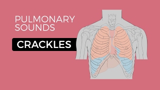 Crackles or Crepitations  Quick amp Easy Overview Easy Lung Sounds [upl. by Eloken]