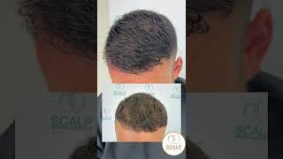 Scalp MicroPigmentation the 1 hair loss treatment density effect hairtattoo smp [upl. by Sabrina]