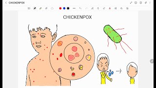 CHICKENPOX [upl. by Windsor]