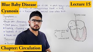 Cyanosis  Blue baby  Cardiovascular disorders  Chapter Circulation video 15 [upl. by Leisam]