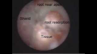 External Root Resorption 2 Viewed with the Perioscope [upl. by Ahsekel964]