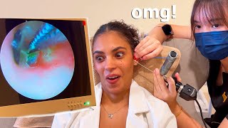 ASMR Deep Ear Cleaning with Tweezers to Remove Earwax [upl. by Aicsile]