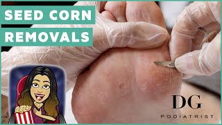 Seed corn removals on feet a Celine Dion fan [upl. by Marjorie163]