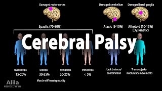 Cerebral Palsy Animation [upl. by Annim]