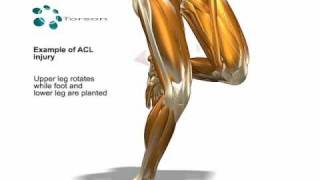 ACL Tear Sports Injury [upl. by Siusan]