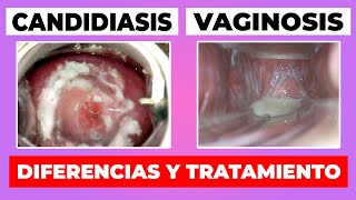 COMO DIFERENCIAR LA CANDIDIASIS DE LA VAGINOSIS BACTERIANA  TRATAMIENTO [upl. by Bamby22]