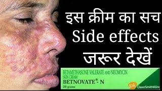 The Shoking Truth Of Betnovate N Cream Betnovate n cream Review and Side effects [upl. by Linker]