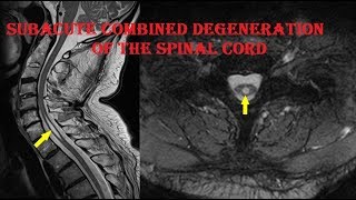 Subacute Combined Degeneration of the Spinal Cord important points drarmin anwar [upl. by Dyl526]